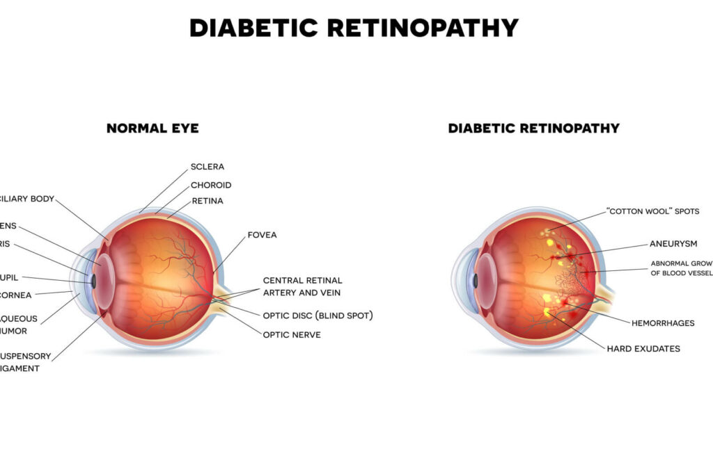 Images of two eyes explained diabetic retinopathy